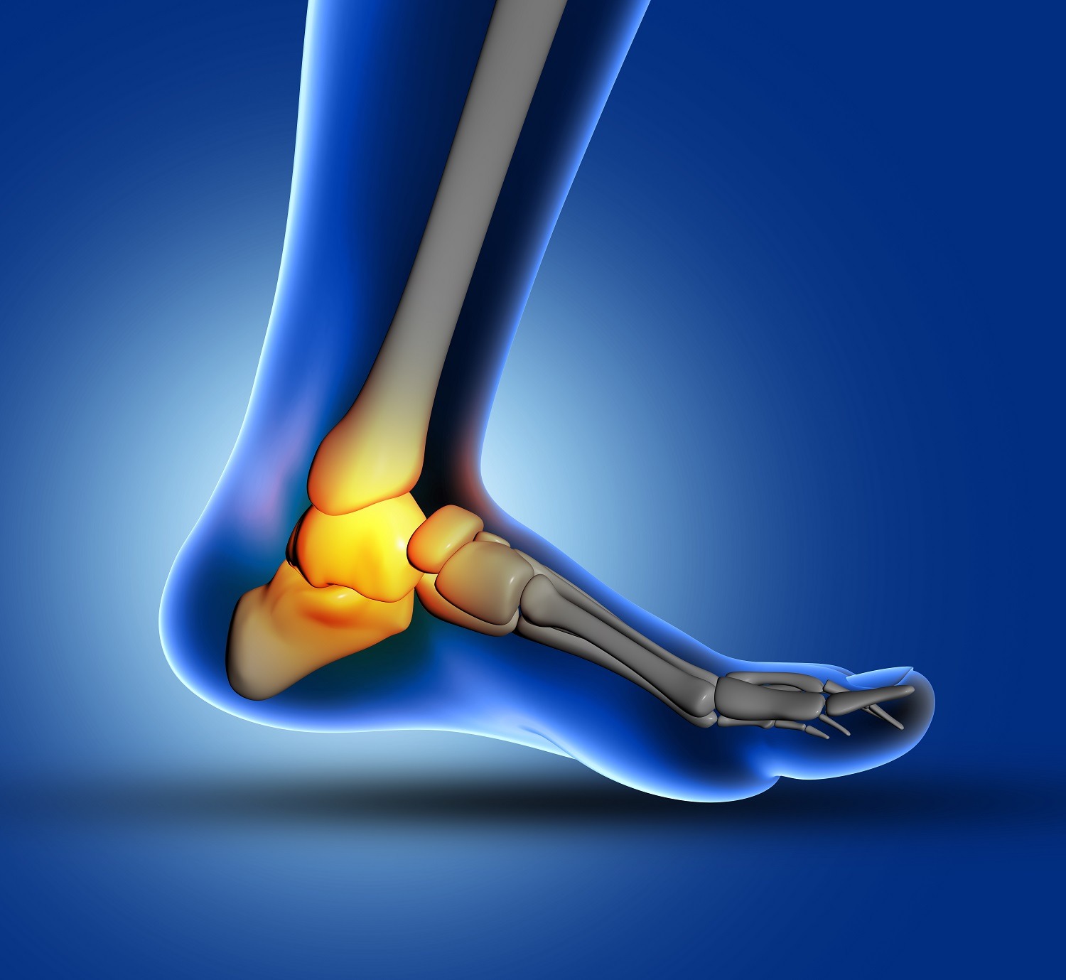 7 Ways to Treat Heel Bone Spurs - Foot and Ankle Group