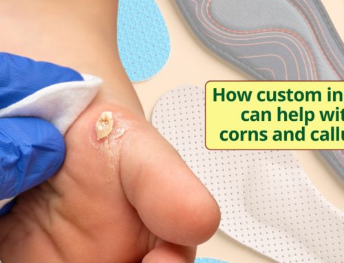 How custom insoles can help with corns and calluses.