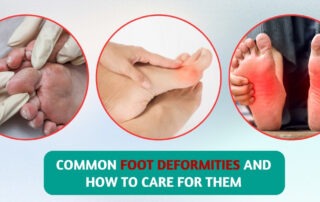 Common Foot Deformities and How to Care for Them