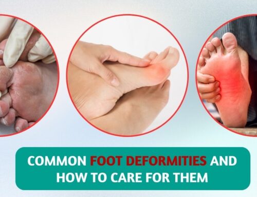 Common Foot Deformities and How to Care for Them