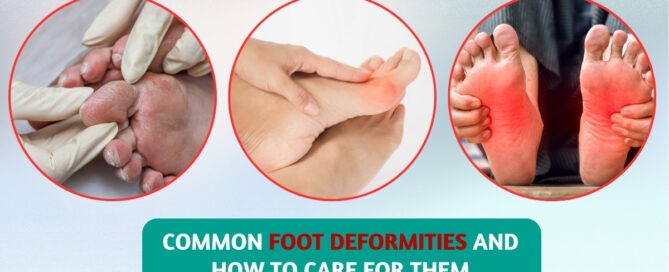 Common Foot Deformities and How to Care for Them